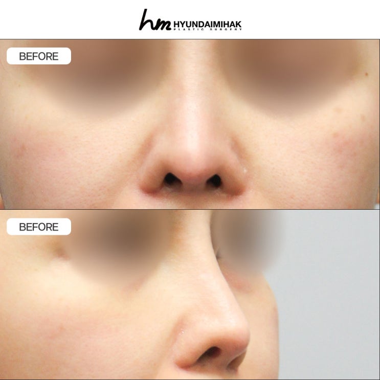 Everything You Need to Know About Upturned Nose Surgery for Natural, Harmonious Results