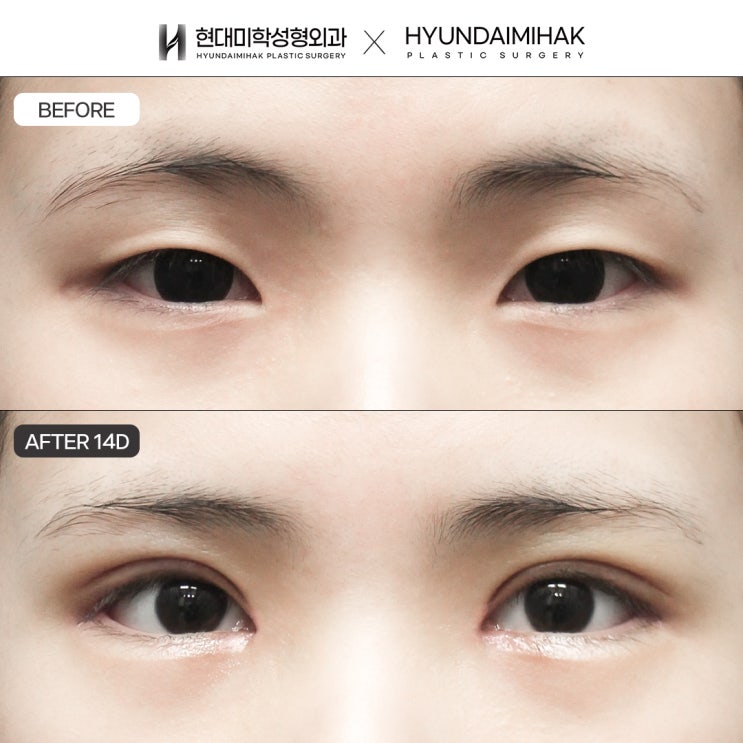 Finding the Right Line for Semi-Out Double Eyelid Surgery