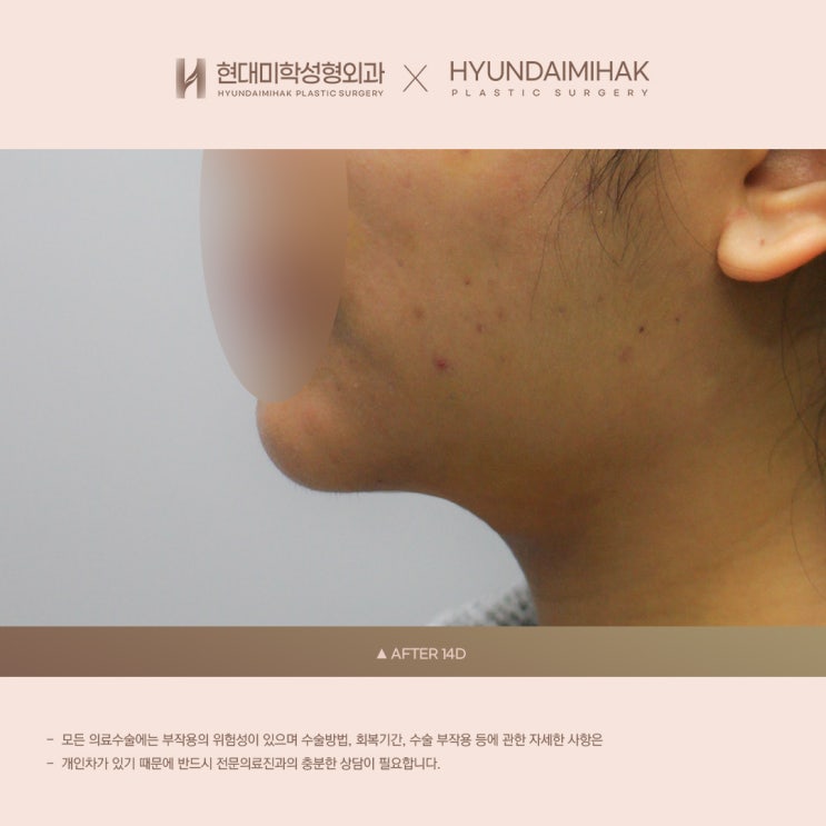 A Facial Contour Correction Method for Deep Cheek Fat That Lifting Alone Cannot Resolve