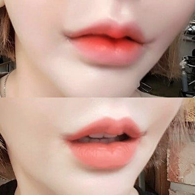 Relieve stress with philtrum surgery