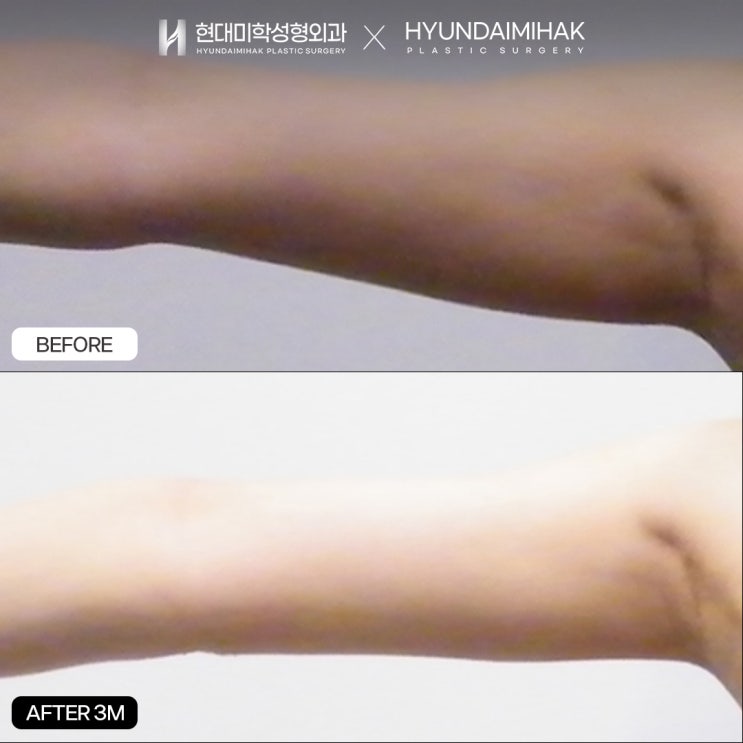Arm Liposuction: A Fast Way to Achieve Slim Arm Lines