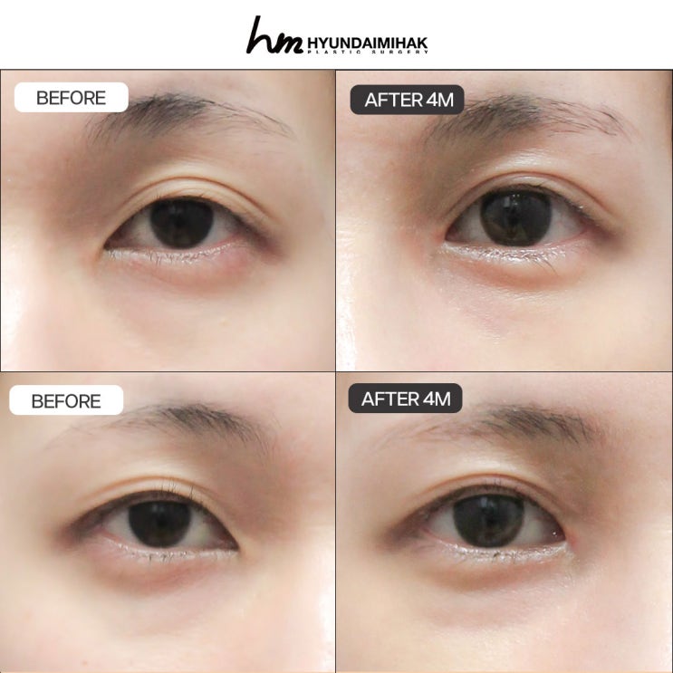 Epicanthoplasty Revision Surgery: Natural, Precise Restoration and Reconstruction Techniques | Recommended Candidates, Surgical Methods, and Recovery Period Explained