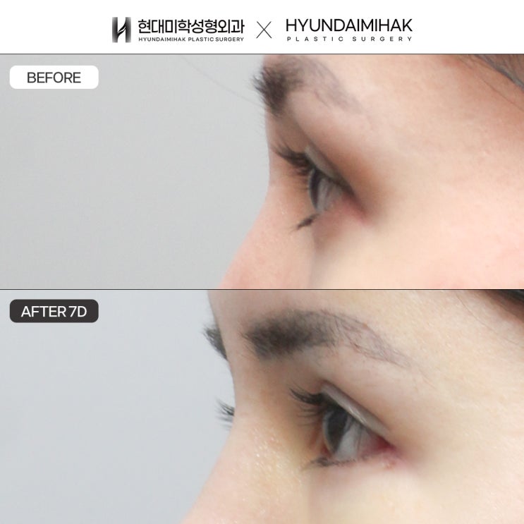 Lowering the Outer Eye Corners: How to Make Small Eyes Look Larger