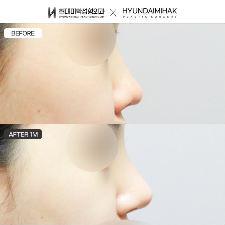 Bulbous Nose Tip Surgery: How to Address Concerns About a Blunt, Rounded Nose Tip