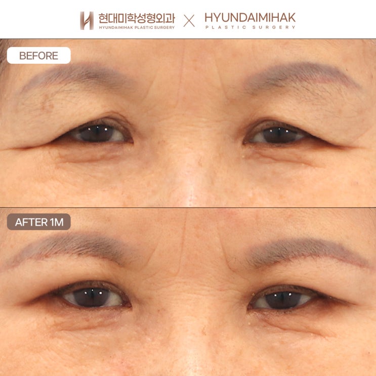 Brow Lift Surgery: Maintaining a Youthful Impression