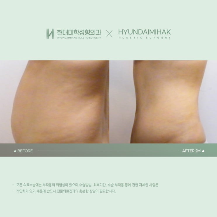 Abdominal Obesity Treatment: An Effective Solution for a Balanced Body Shape