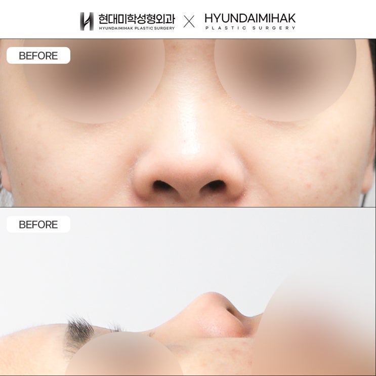 Various Approaches to Improving a Short Nose