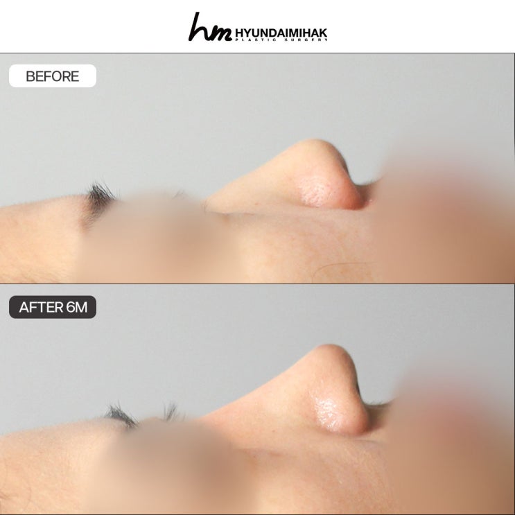 Why should you choose Hyundai Aesthetic Surgery for donor rib cartilage and autologous rib cartilage rhinoplasty?