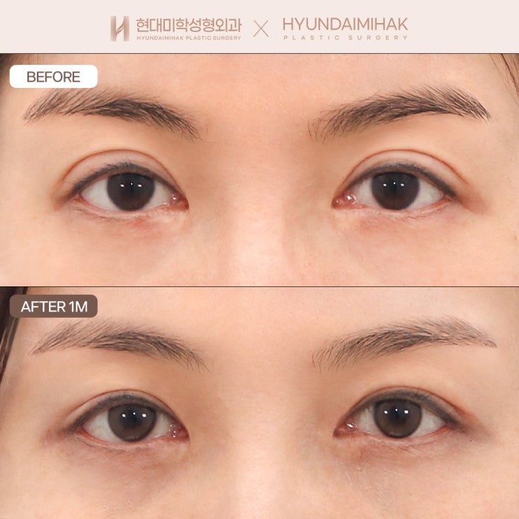 When thick double eyelids feel too heavy and you want to lower them