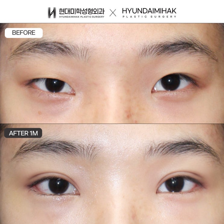 Criteria for Choosing Non-Incisional Double Eyelid Surgery