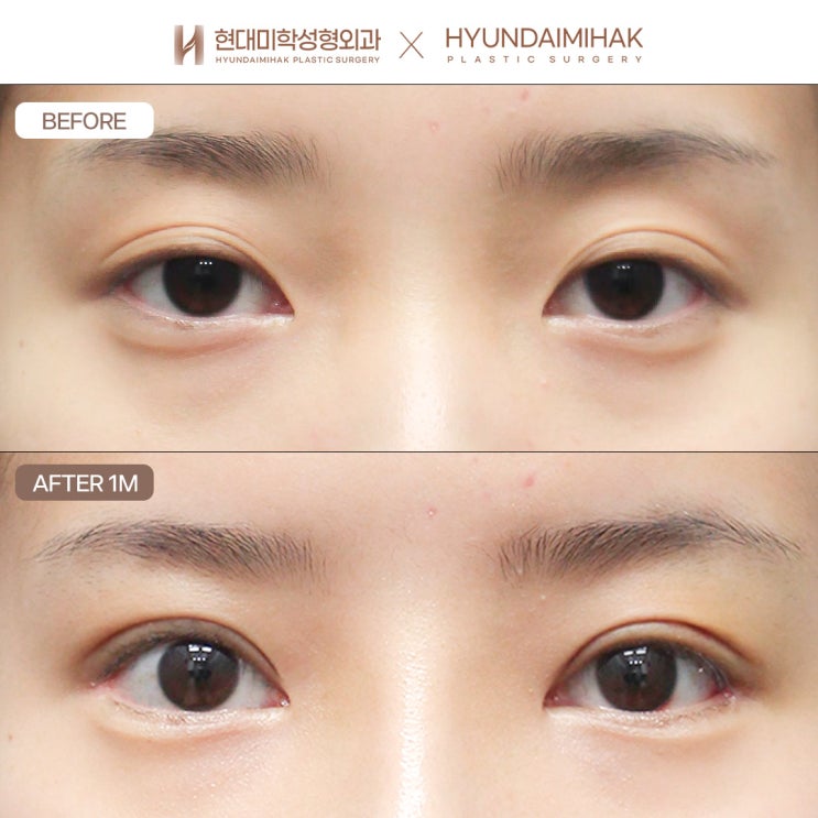 Non-incisional double eyelid surgery that feels comfortable and looks natural