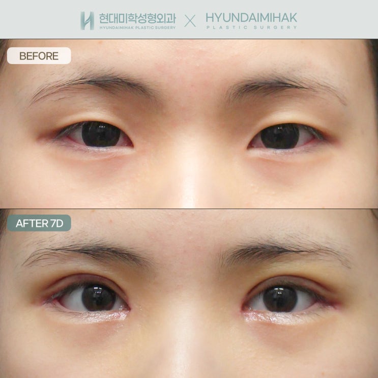 How to Proceed Safely with Incisional Double Eyelid Surgery