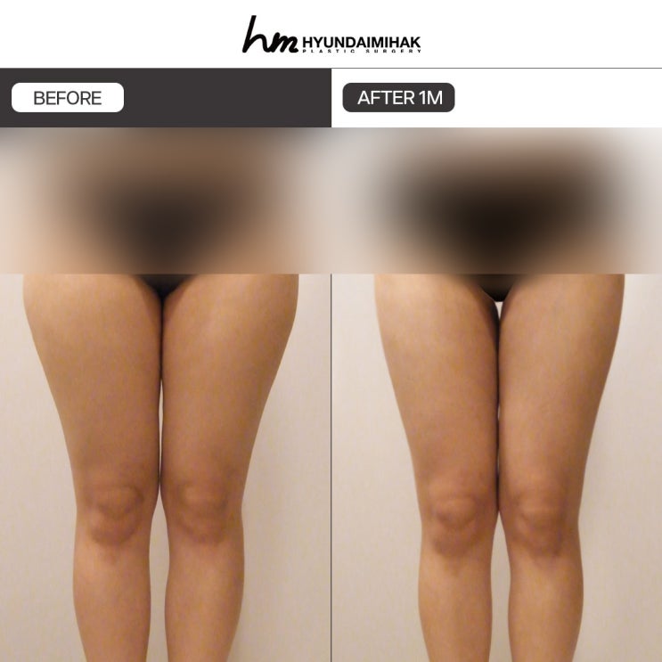 Lower-Body Liposuction: A Solution That Changes Your Confidence