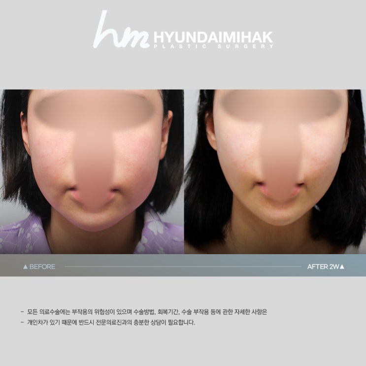 SMAS Lifting: An anti-aging solution with minimal incisions and maximum results