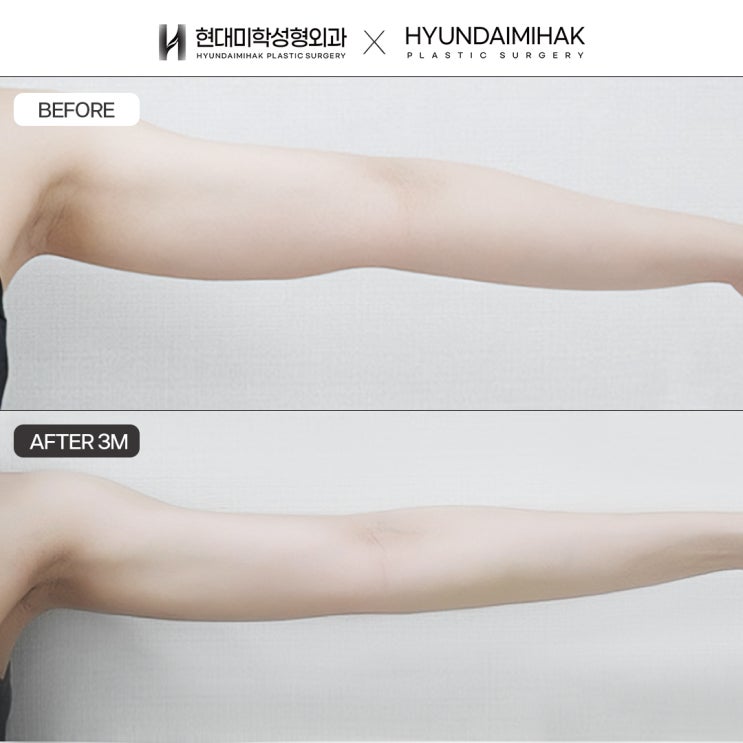 Resolving Sagging Upper Arm Fat Quickly and Effectively with Arm Liposuction