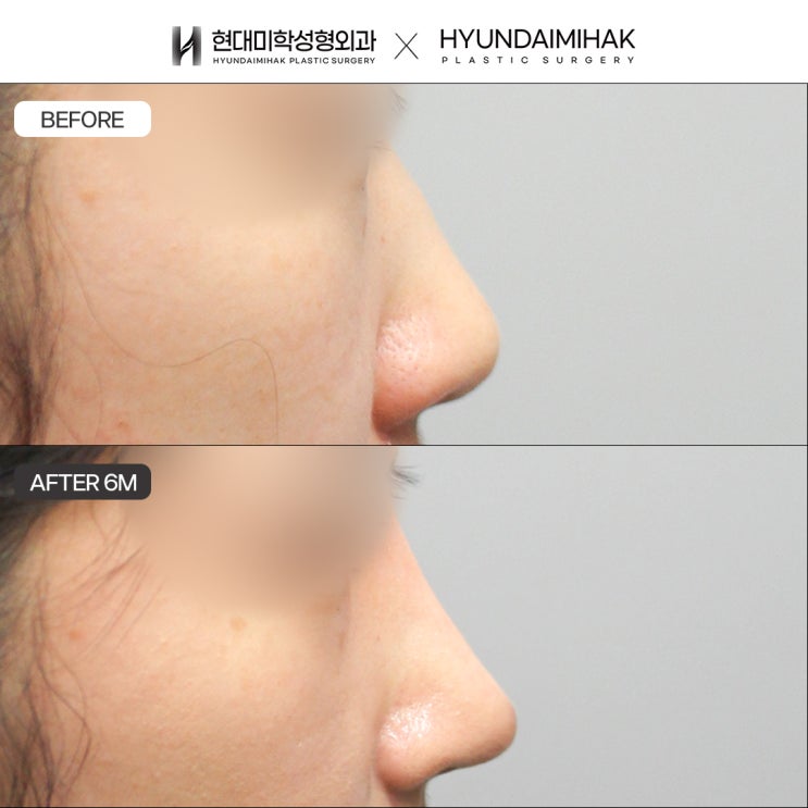 If you need a well-known rhinoplasty clinic with thorough consultation