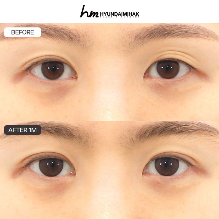 Incisional Double Eyelid Revision FAQ │ Please read before deciding on revision surgery