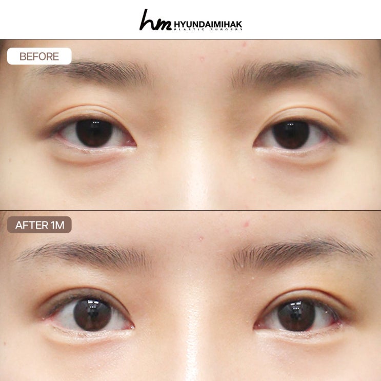 6 Things People Are Most Curious About Regarding Non-Incisional Double Eyelid Surgery
