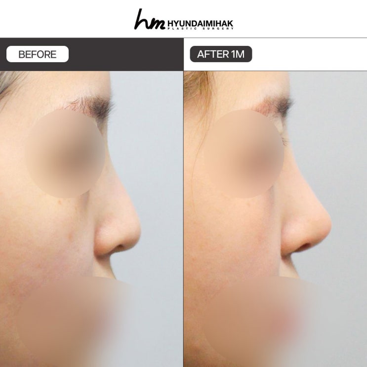 How to Choose a Truly Excellent Rhinoplasty Clinic