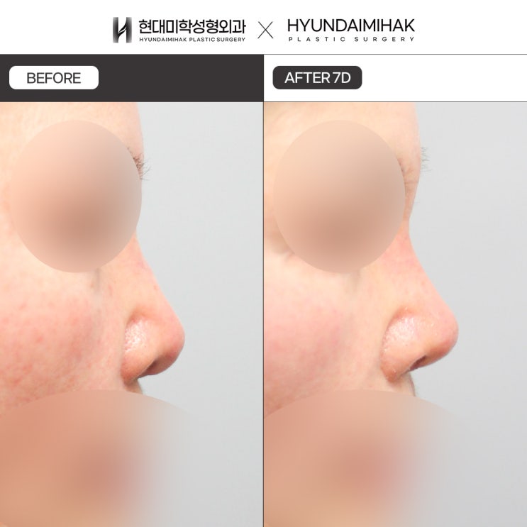 Rhinoplasty Revision Cost and Key Points for a Successful Revision Surgery