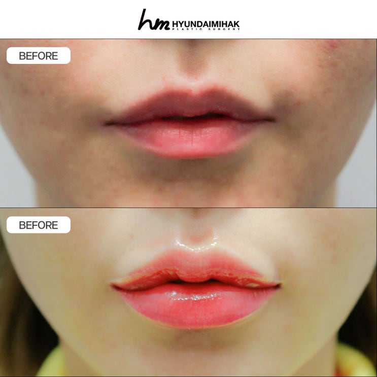 Lip Surgery Cost: A One-Step Method to Improve the Lip Line