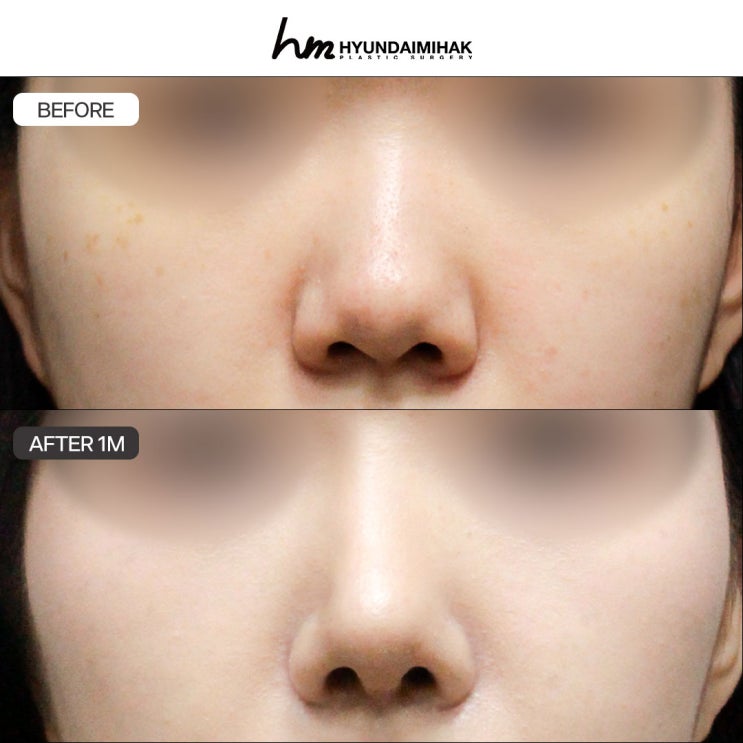 Straight-dorsum with a subtle upturn nose line, completing natural sophistication