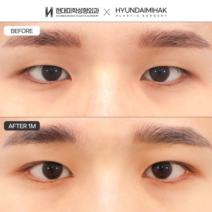 Male Ptosis Correction Cost While Keeping It Reasonable