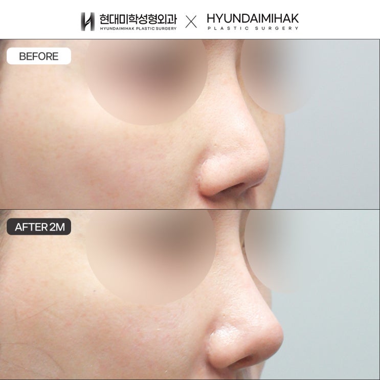 To help resolve concerns about rib cartilage rhinoplasty