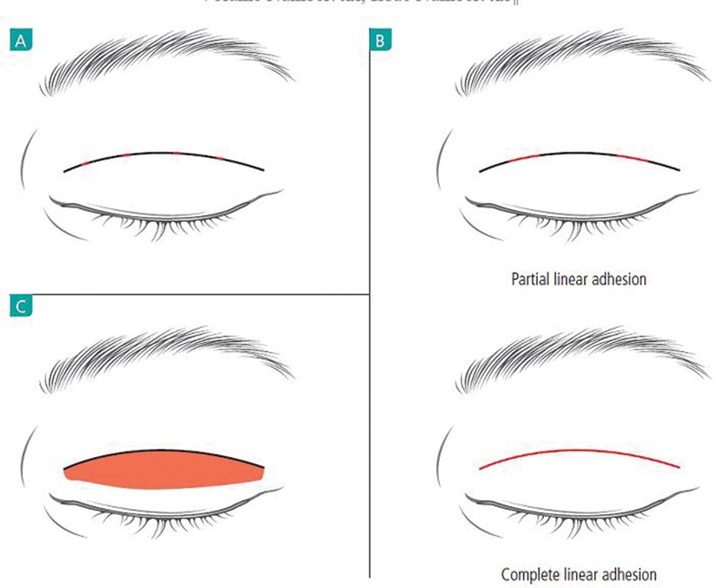 Schematic of point, linear, and planar adhesion between the anterior and posterior eyelid layers.