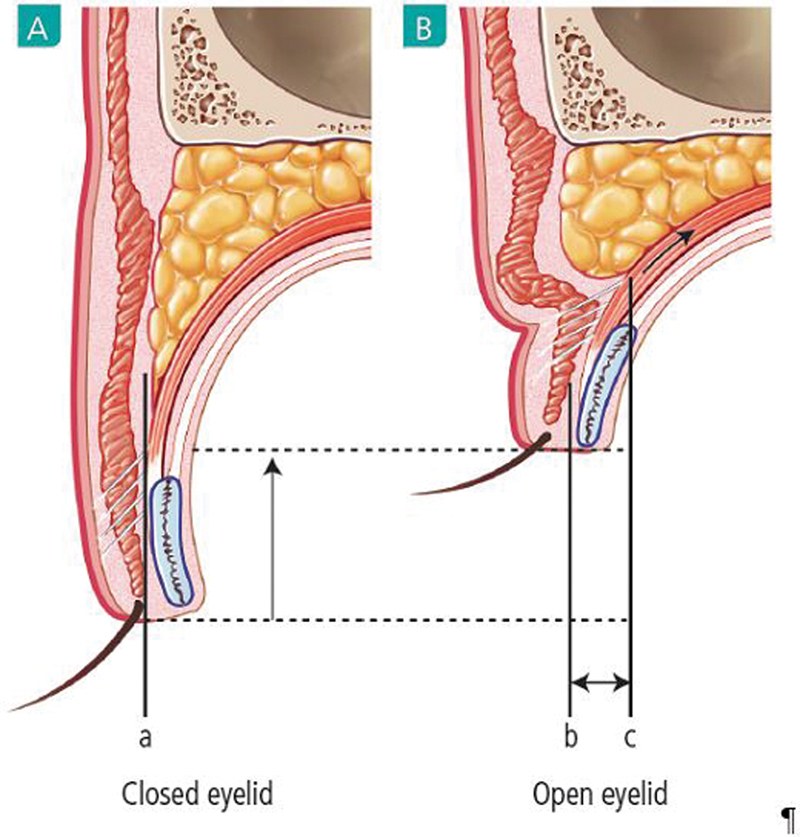 Cross-sectional anatomy of the upper eyelid, closed and open. Opening the eye folds the skin inward at the connection point.