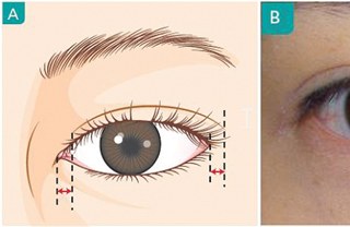 Diagram of where a double-eyelid crease line starts and ends.