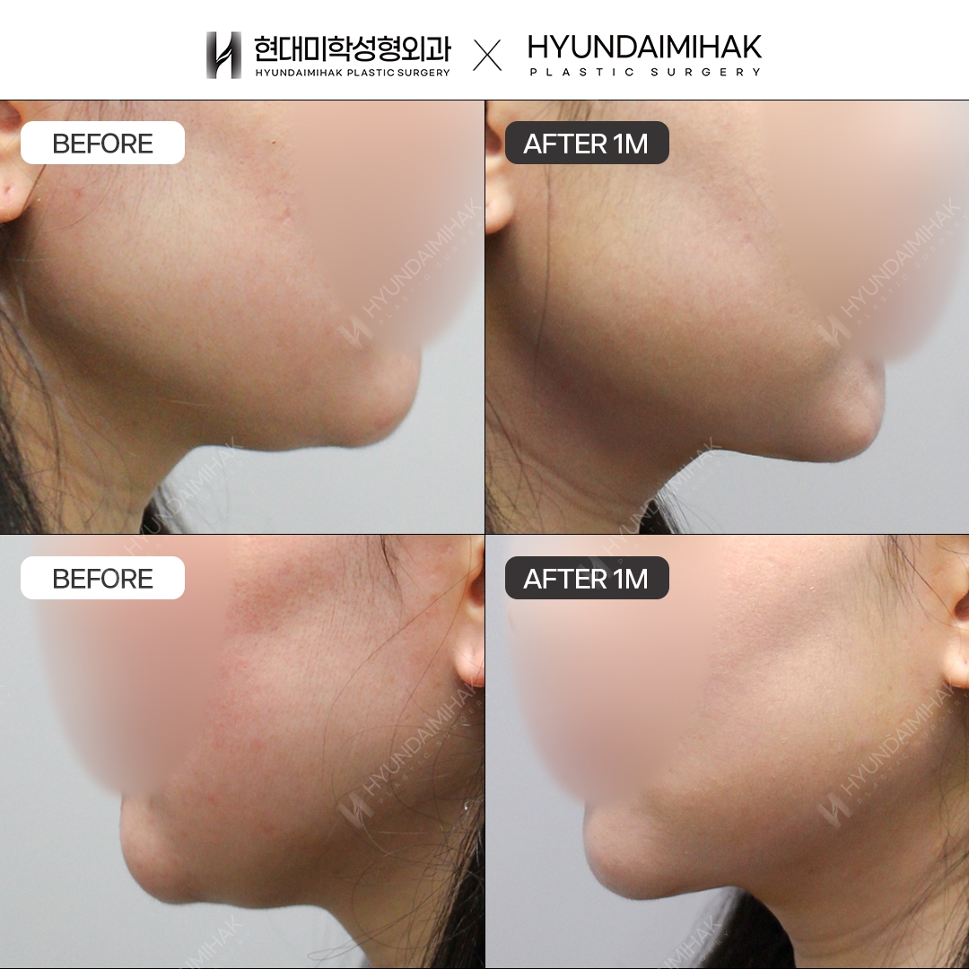 [Facial Rejuvenation] Thread Lift, 1 Month Later