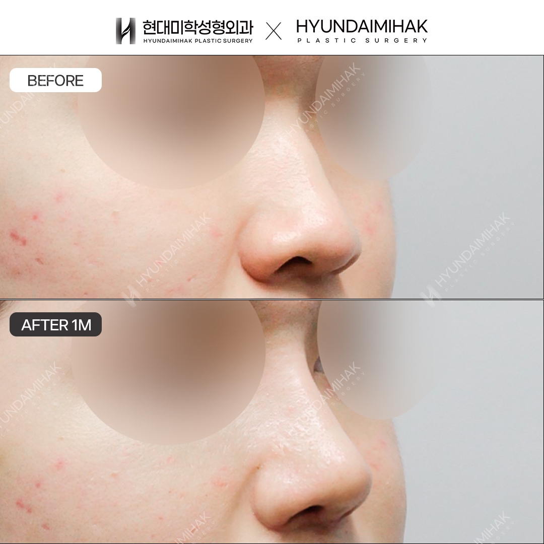 [Male rhinoplasty] Nasal bridge + nasal tip, 1 month post-op