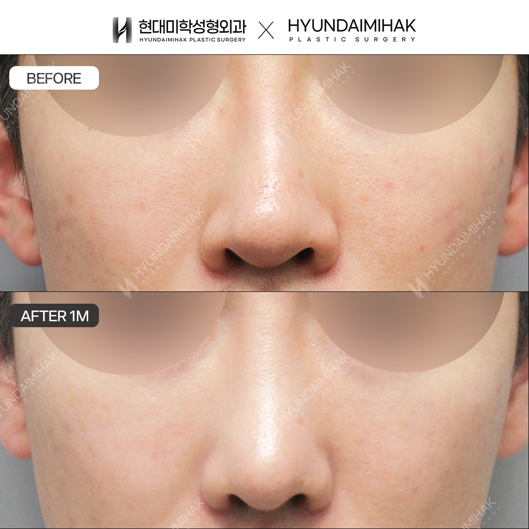 [Male rhinoplasty] Nasal bridge + nasal tip, 1 month post-op