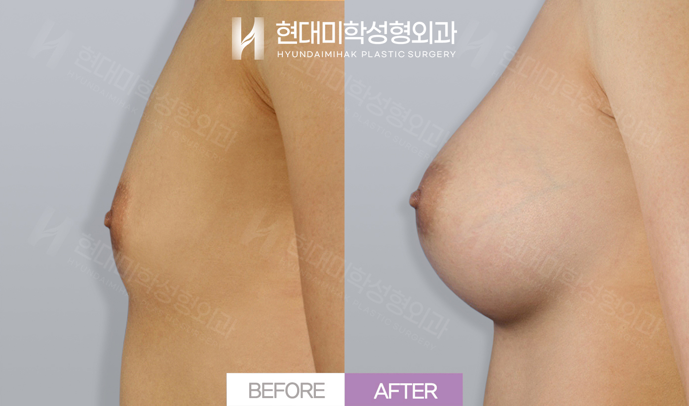 Breast Augmentation (Silicone)