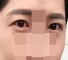 Men's double eyelid surgery review ㅋㅋㅋ