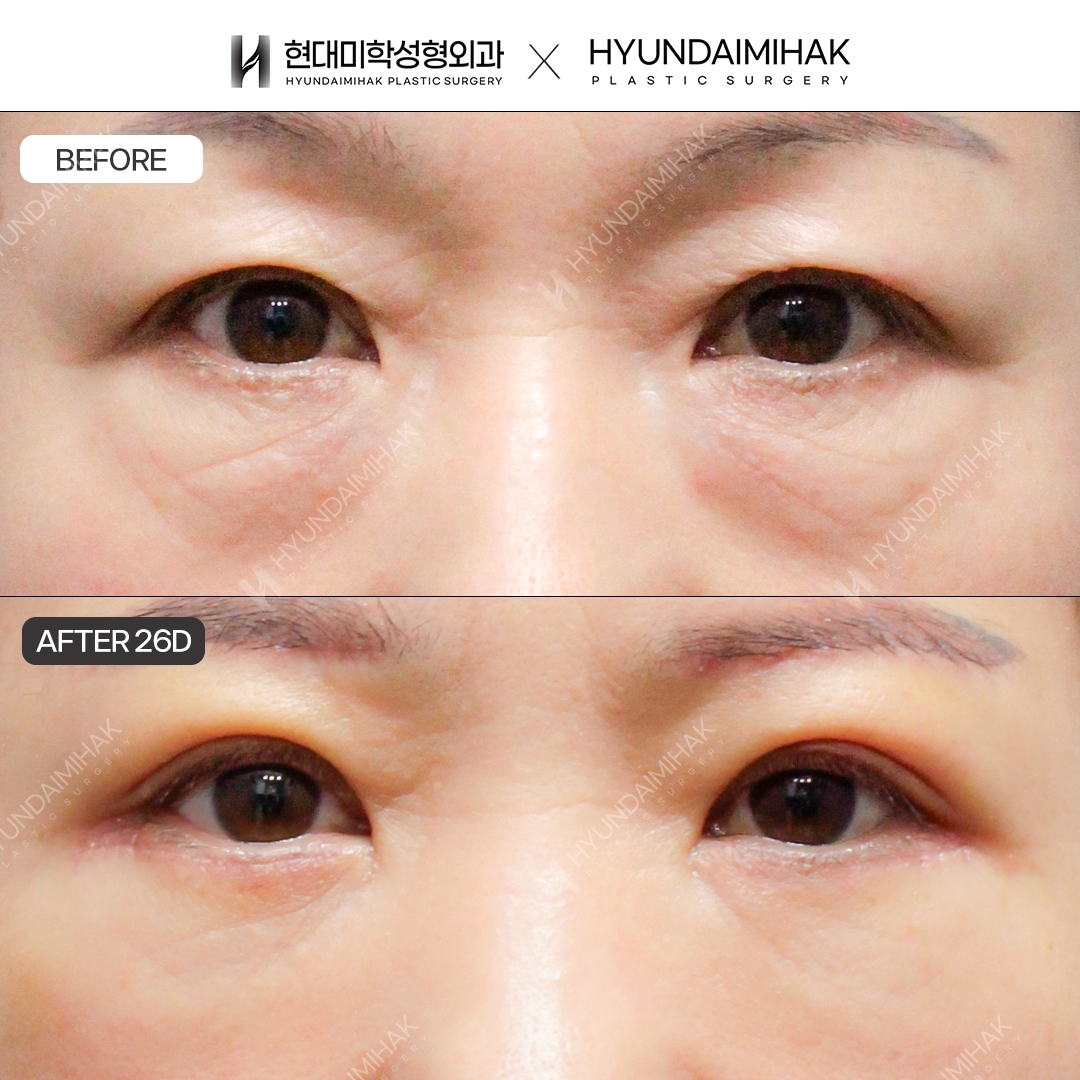 [Middle-aged eye surgery] Upper blepharoplasty + lower blepharoplasty + under-eye fat repositioning