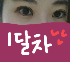 I brought before-and-after photos of ptosis correction and incisional double eyelids~^^