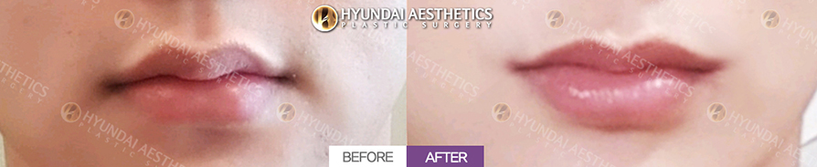 Mouth Corner Lift + Marionette Lines + Mouth Width Extension