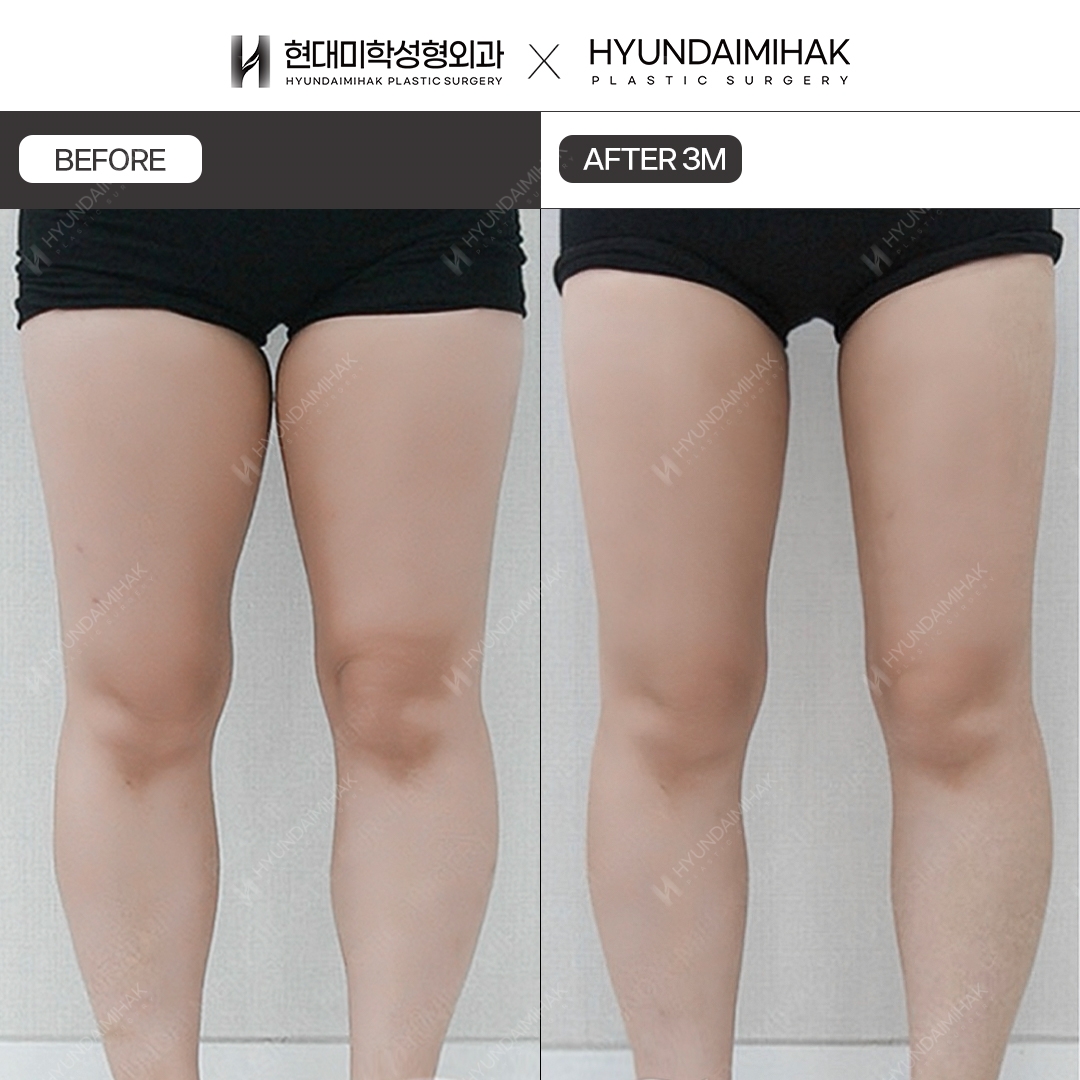 3 months after thigh liposuction
