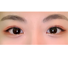 My First Eye Surgery Was a Success