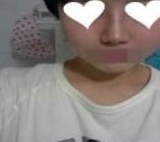 I Had Nose Surgery~~~