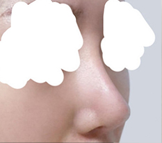 Improving a blunt nose