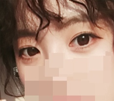Canthoplasty is amazing, the best >3<