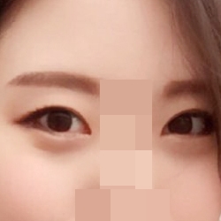 Perfect Big Eye plus extra canthoplasty!