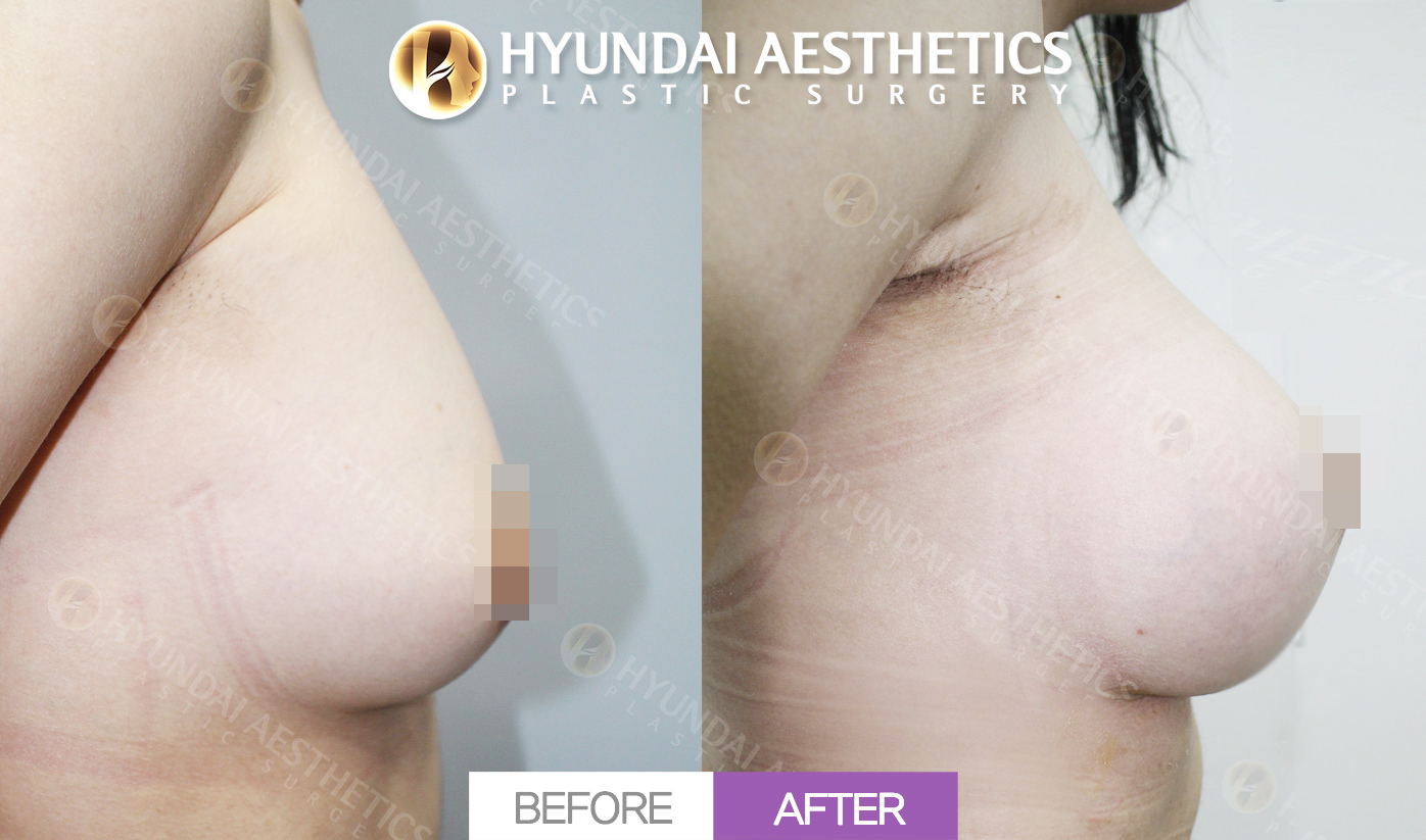 Revision Breast Augmentation (Motiva Implants)