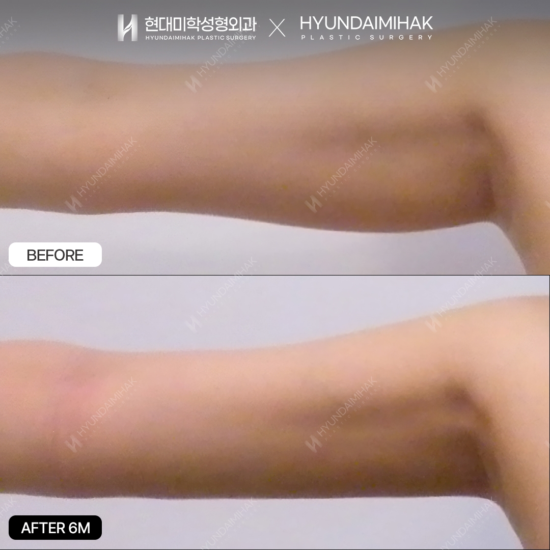 6 months after upper-arm liposuction