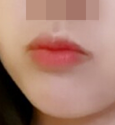After mouth-corner surgery, I became popular lol