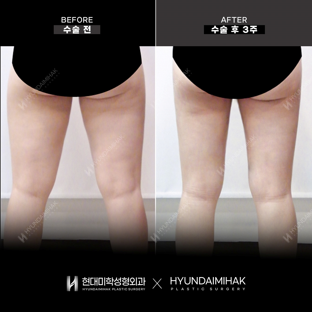Thigh liposuction, 3 weeks after surgery