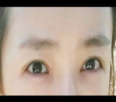 My revision eye surgery was a success!